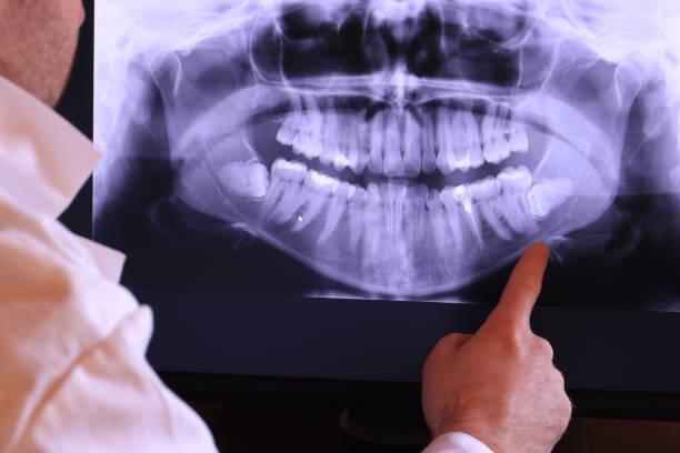 Best Emergency Treatment for Dental Infections or Abscesses in Lake Los Angeles, CA