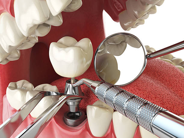 Best Emergency Dental Care for Broken or Chipped Teeth in Lake Los Angeles, CA